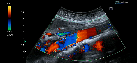 aorta ecocolordoppler